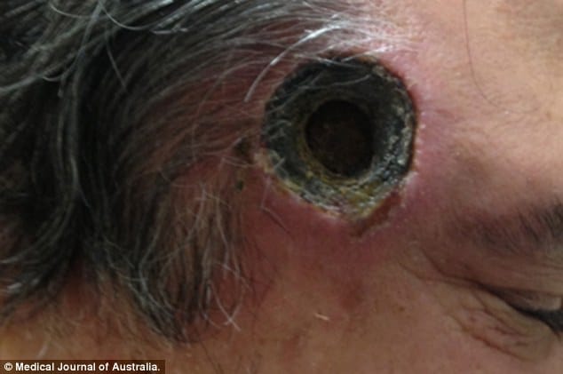 Black salve ointment leaves inch wide hole in Aussie man's ...