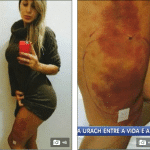 Pictures: Andressa Urach, Miss BumBum runner up fighting for her life after botched plastic surgery