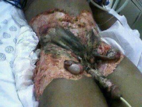 images-Jealous_woman_bathes_boyfriend_with_acid_241829773