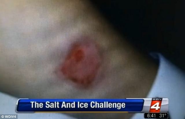 Salt and ice burn challenge