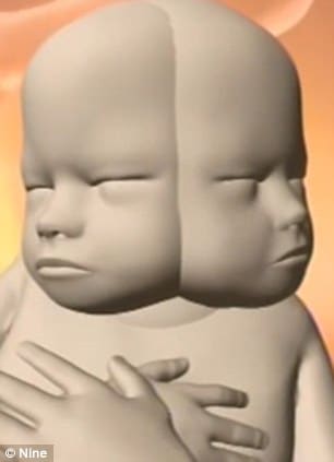 Parents refuse to abort baby with two faces 