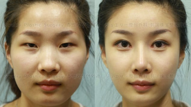 Plastic Surgery In South Korea That You Need A New Passport Western Eyes 