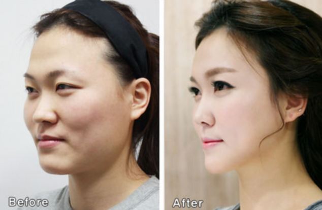 Plastic Surgery In South Korea That You Need A New Passport Western Eyes 