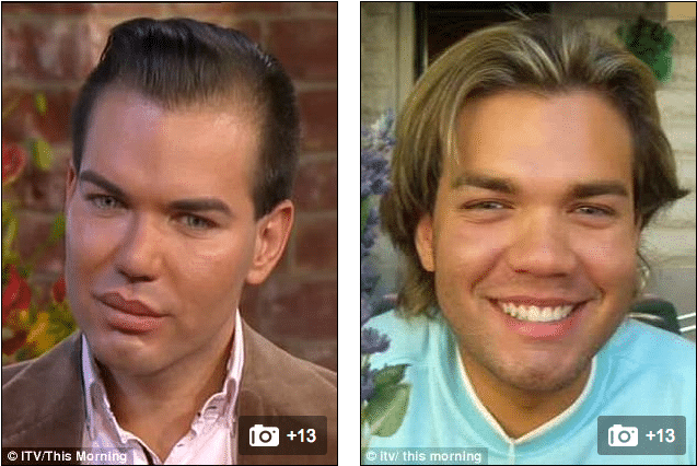 Rodrigo Alves plastic surgery