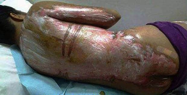 Filipino maid suffers burns after Saudi boss throws boiling water