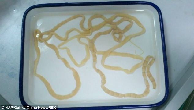 Chinese woman has eight ft long tapeworm removed 
