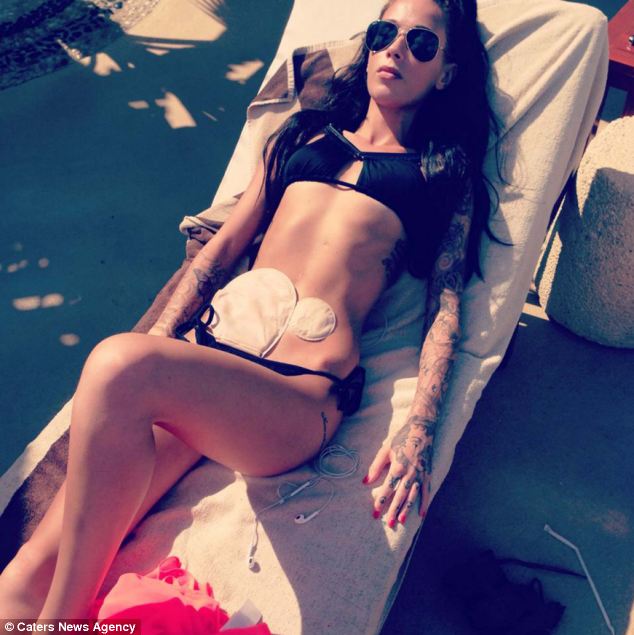 bikini photo of Bethany Townsend with colostomy bag