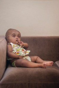 Roona Begum operation, Indian baby with swollen head defies the odds.