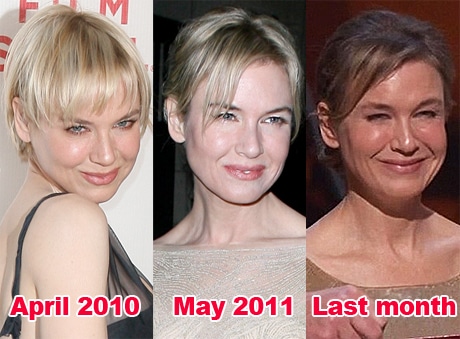 Renee Zellweger plastic surgery.