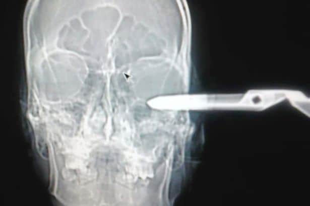 Mexican man stabbed in the face with scissors