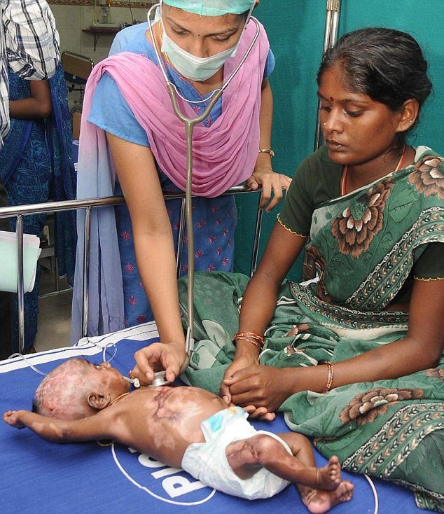 Indian baby spontaneously combust