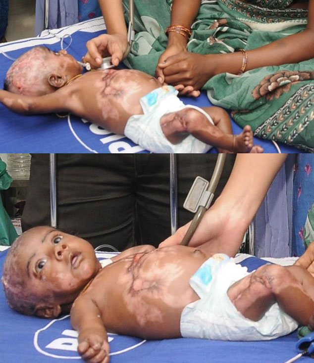 Indian baby spontaneously combust