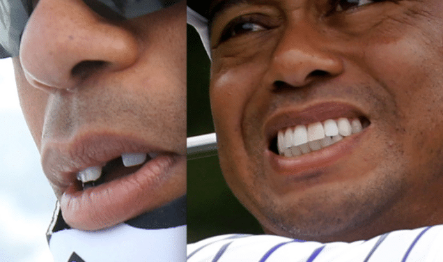 Tiger Woods without his fake front tooth