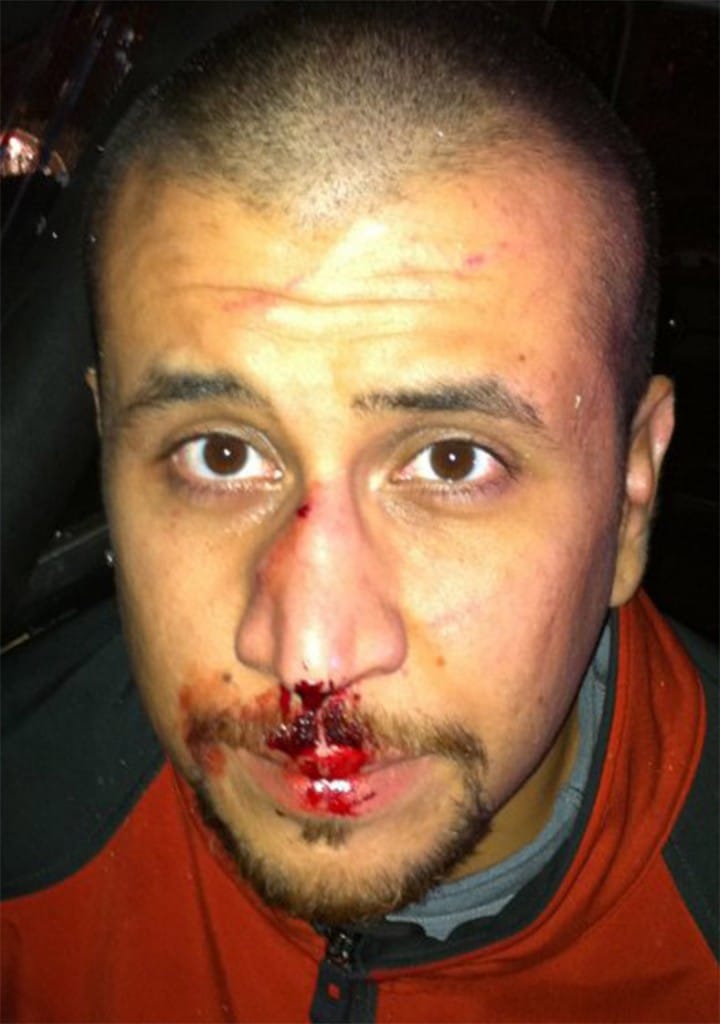 George Zimmerman shot in face 
