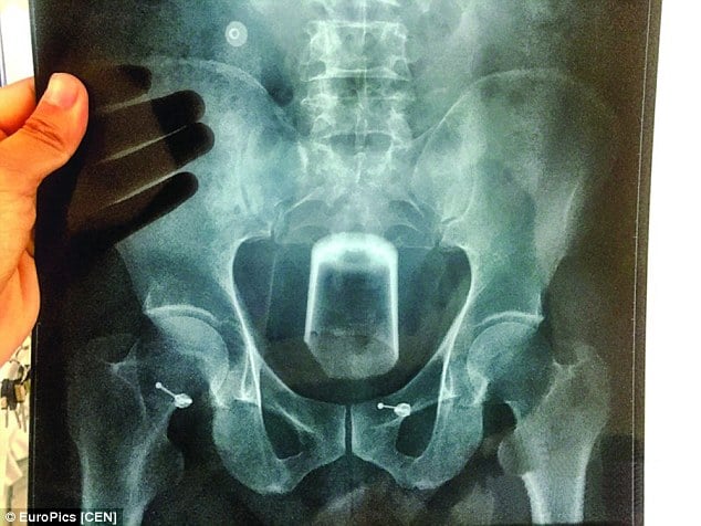 Chinese man inserts three inch wide beer glass in his rectum