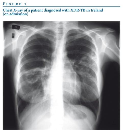 XDR-TB tuberculosis