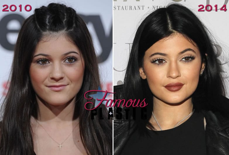 Kylie Jenner beauty regiment plastic surgery