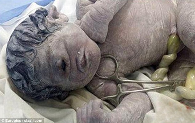 Egyptian Cyclops baby born with one eye after mom exposed to radiation
