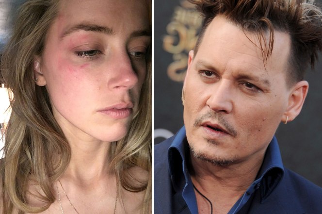 Amber Heard black eye