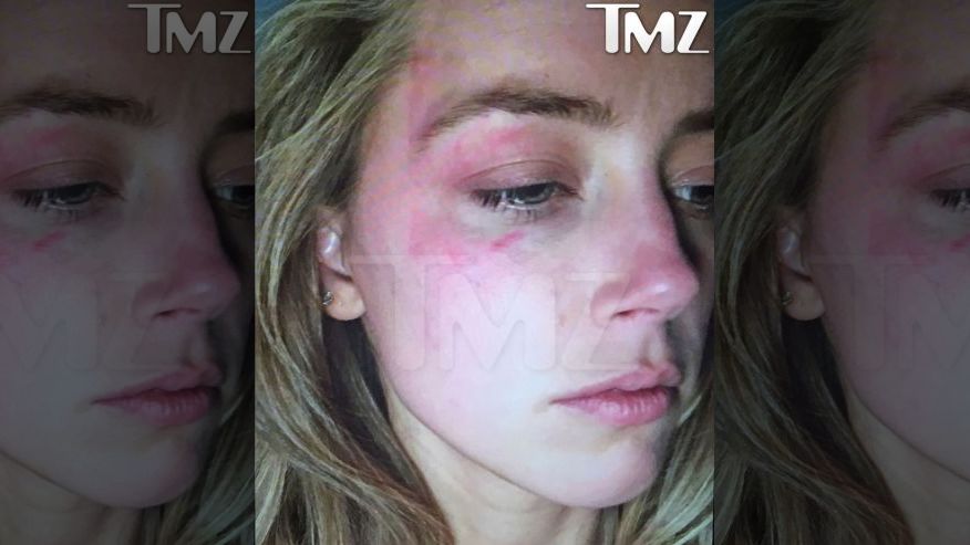 Amber Heard black eye