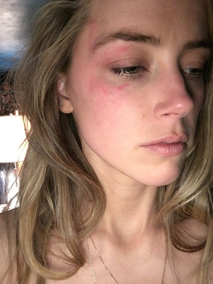 Amber Heard new abuse photos
