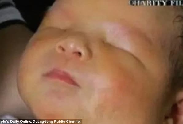Chinese baby born with no eyes