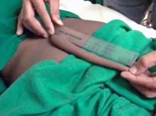 Indian boy 8 inch tail removed