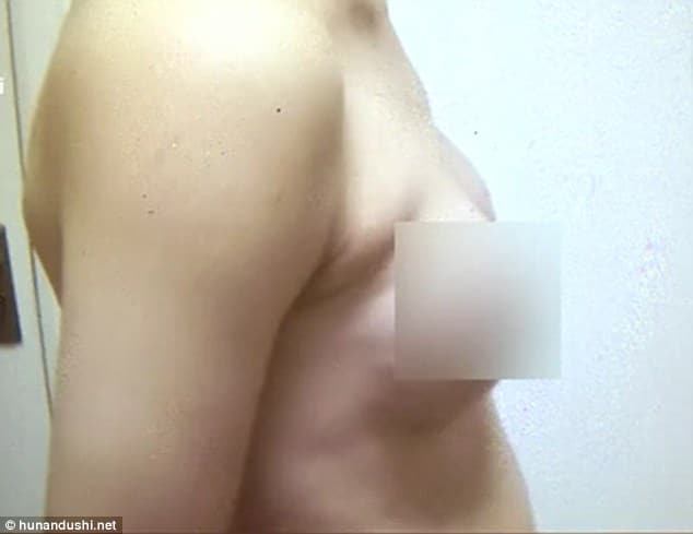 Unemployed Chinese man gets breasts implants 