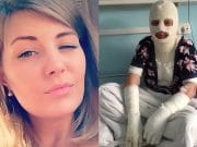 Yekaterina M: My jealous Russian boyfriend poured acid on my face Yekaterina M