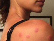 Photos: Victoria’s Secret model sues hotel over bed bug ‘massacre’ that ‘ruined’ her career. Sabrina Jales St. Pierre