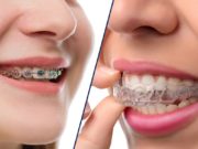 Crooked teeth