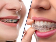 Crooked teeth