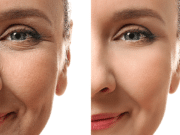 9 Secrets About How to get rid of smile lines without surgery Getting rid of smile lines without surgery.