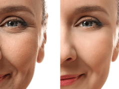 Getting rid of smile lines without surgery.