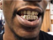 Why Would You Wear Custom Gold Grillz? Custom Gold Grillz