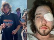 $58K: Indiana protester loses eye after struck in the face by police tear gas canister Balin Brake eye