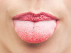 Vapers Tongue
