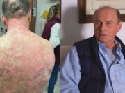 Virginia man, 74, skin peels off after J&J COVID vaccine: still safe? Richard Terrell vaccine