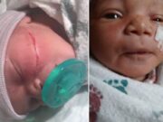 Colorado newborn face sliced open during emergency C section: 13 stitches Kyanni Williams Colorado newborn baby