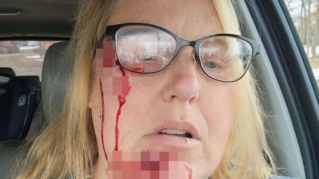 Rhonda Stickney, Minnesota grandmother mauled by pitbull protecting her grandkids