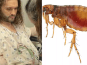 Michael Kohlhof double amputation typhus from single flea bite.