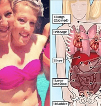 Abby and Brittany Hensel conjoined twins sex life with Josh Bowling
