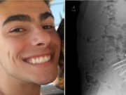 Luigi Mangione back pain & spinal surgery led to alleged CEO shooter targeting UnitedHealthcare in manifesto.