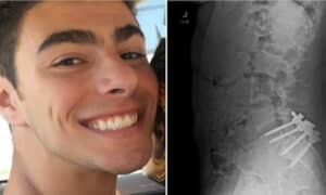 Luigi Mangione X ray of stapled spine alludes to bungled surgery